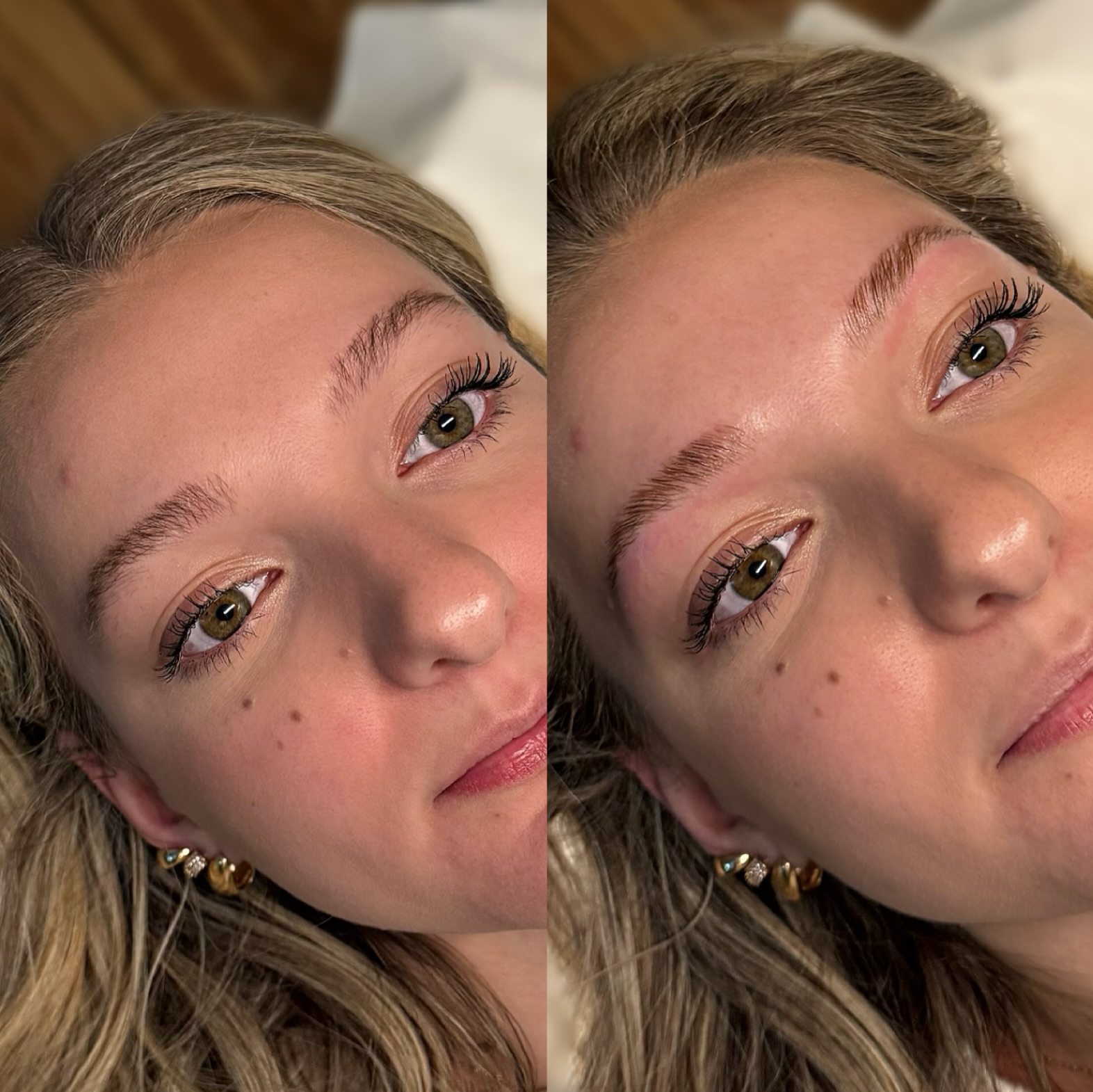 Brow before and after